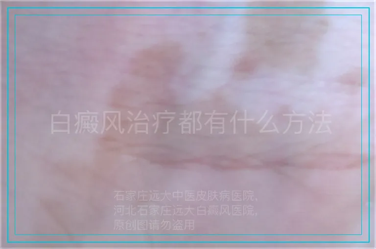 白癜风治疗都有什么方法
