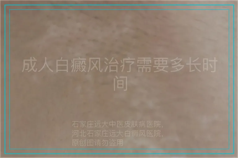 成人白癜风治疗需要多长时间