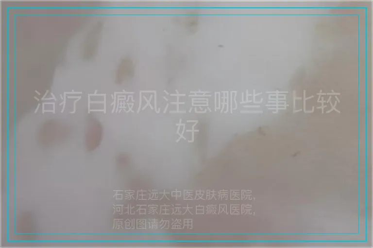 治疗白癜风注意哪些事比较好