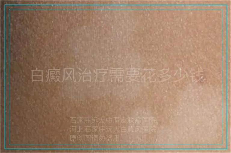 白癜风治疗需要花多少钱