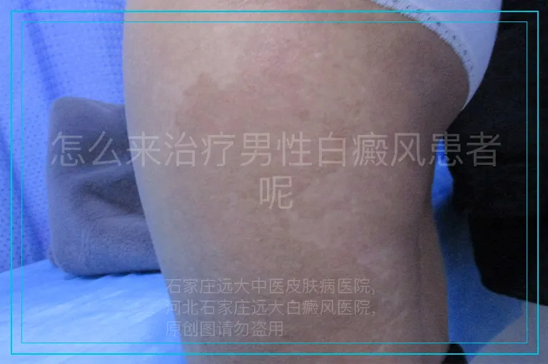 怎么来治疗男性白癜风患者呢