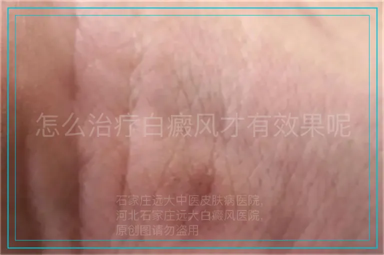怎么治疗白癜风才有效果呢