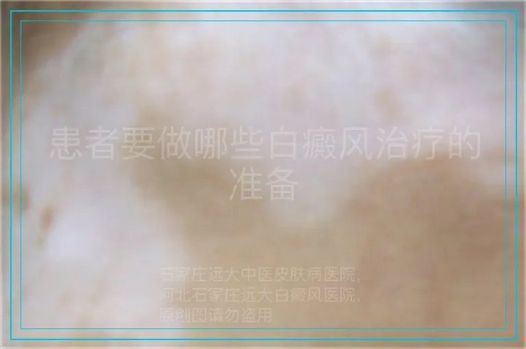患者要做哪些白癜风治疗的准备