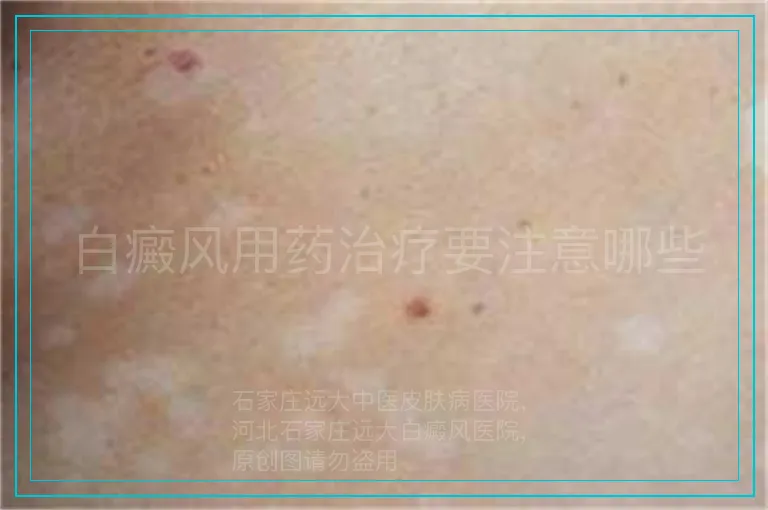 白癜风用药治疗要注意哪些