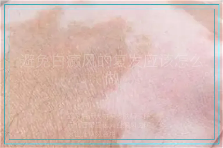 避免白癜风的复发应该怎么做