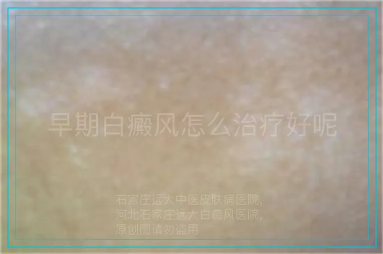早期白癜风怎么治疗好呢