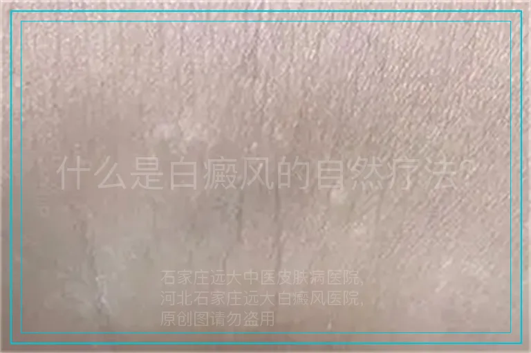 什么是白癜风的自然疗法?