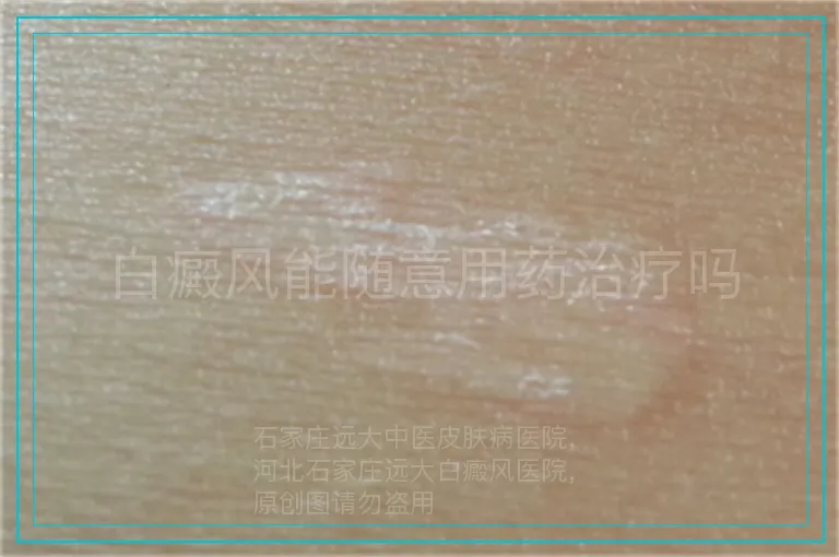 白癜风能随意用药治疗吗