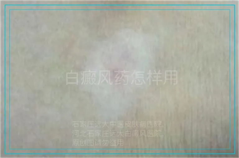 白癜风药怎样用