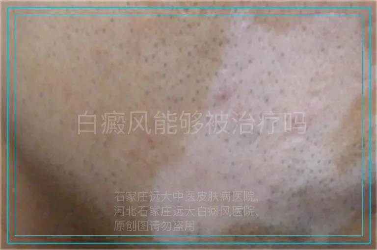 白癜风能够被治疗吗