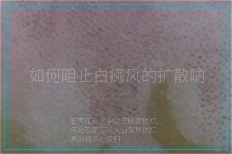 如何阻止白癜风的扩散呐