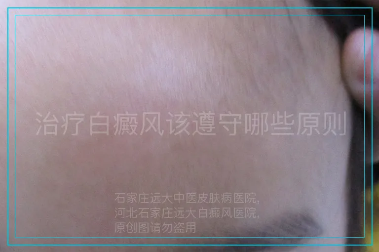 治疗白癜风该遵守哪些原则