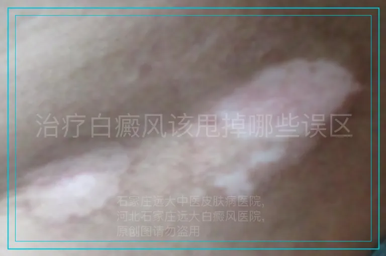 治疗白癜风该甩掉哪些误区
