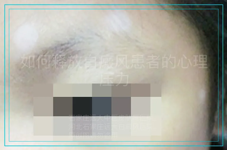 如何释放白癜风患者的心理压力