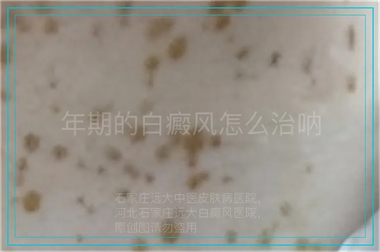 年期的白癜风怎么治呐