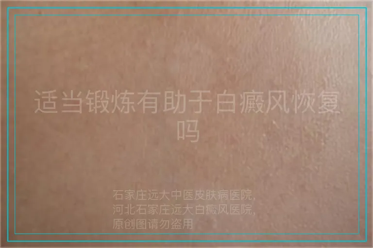 适当锻炼有助于白癜风恢复吗
