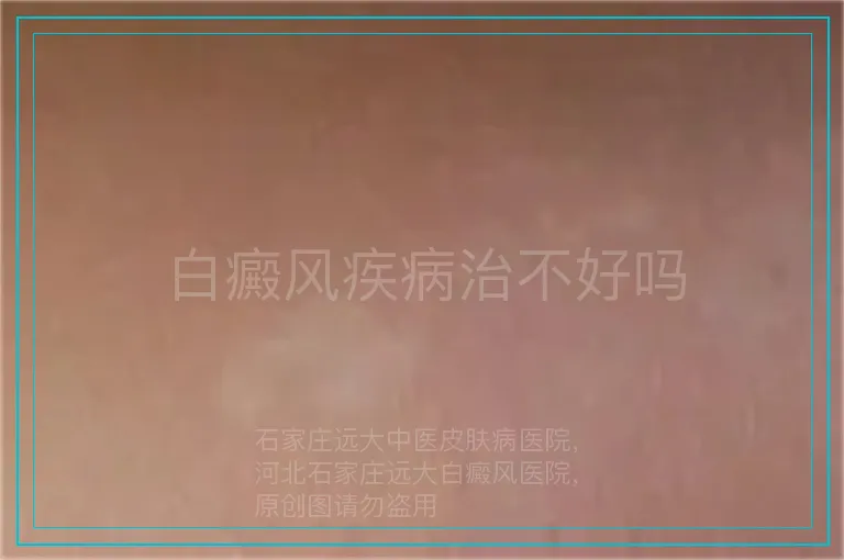 白癜风疾病治不好吗
