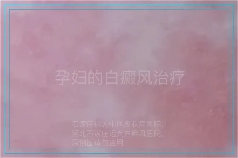 孕妇的白癜风治疗