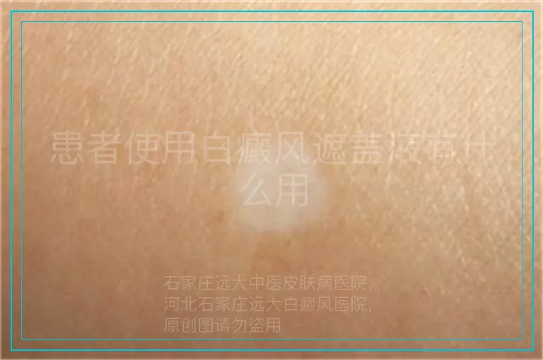 患者使用白癜风遮盖液有什么用