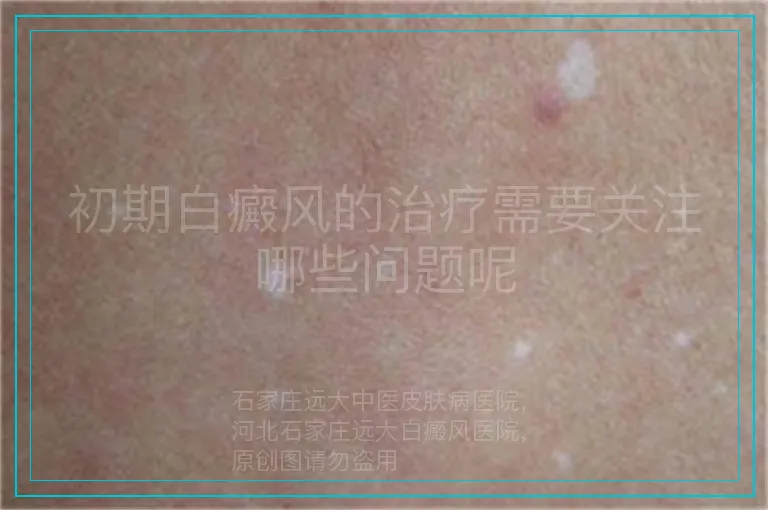 初期白癜风的治疗需要关注哪些问题呢