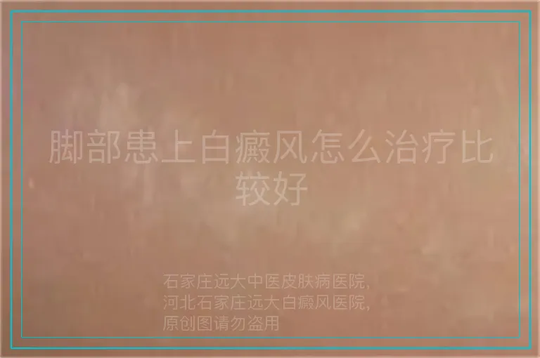 脚部患上白癜风怎么治疗比较好