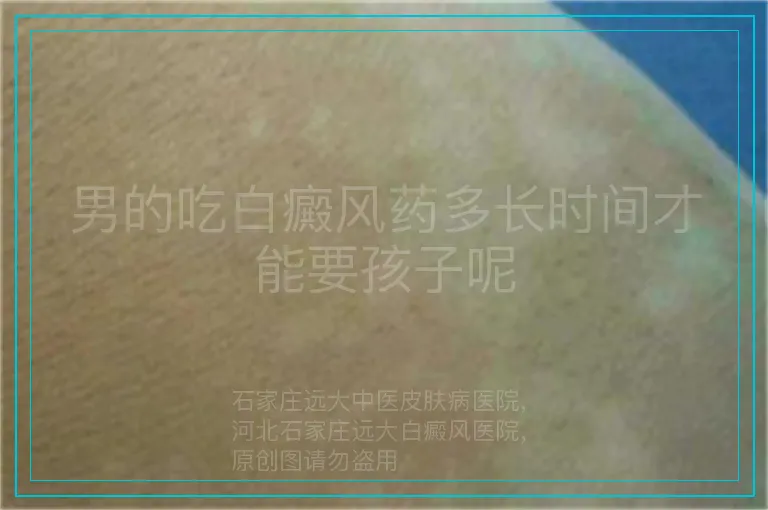 男的吃白癜风药多长时间才能要孩子呢
