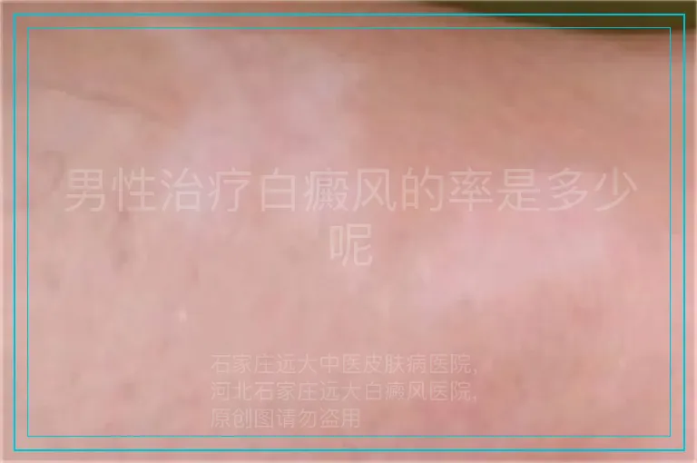 男性治疗白癜风的率是多少呢