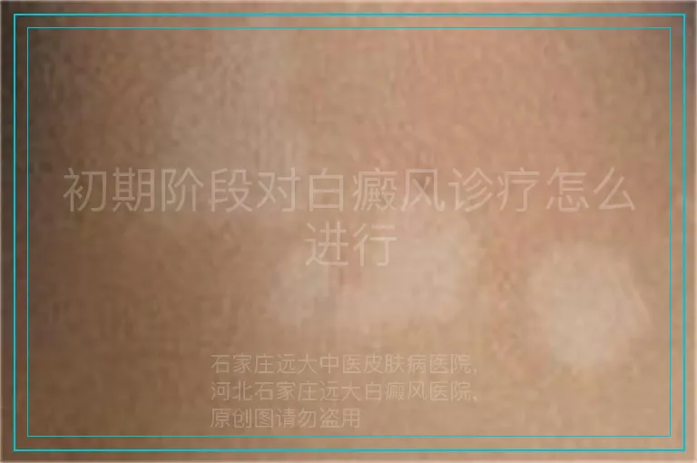 初期阶段对白癜风诊疗怎么进行