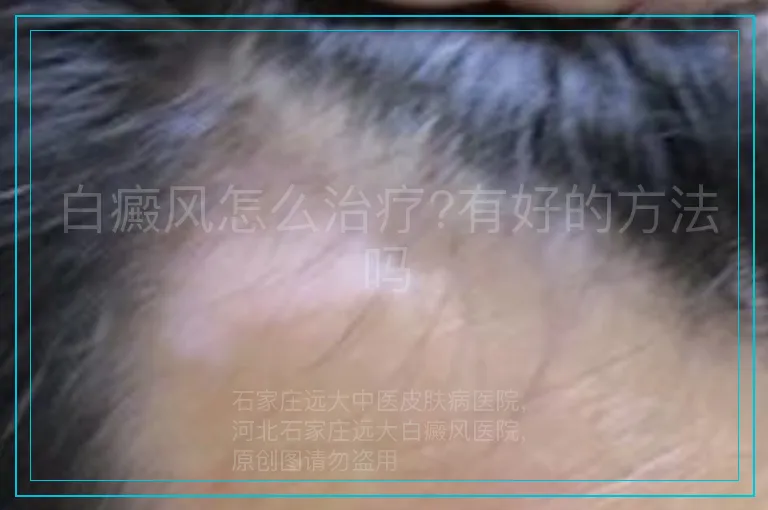 白癜风怎么治疗?有好的方法吗