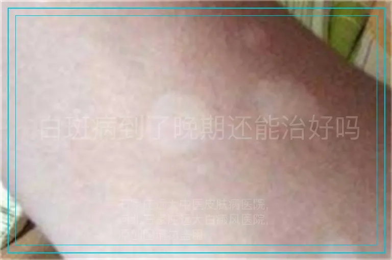 白斑病到了晚期还能治好吗