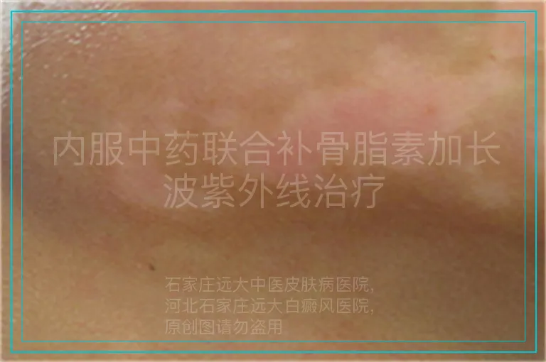 内服中药联合补骨脂素加长波紫外线治疗