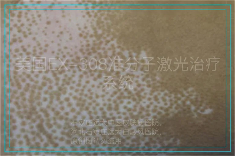 美国EX-308准分子激光治疗系统
