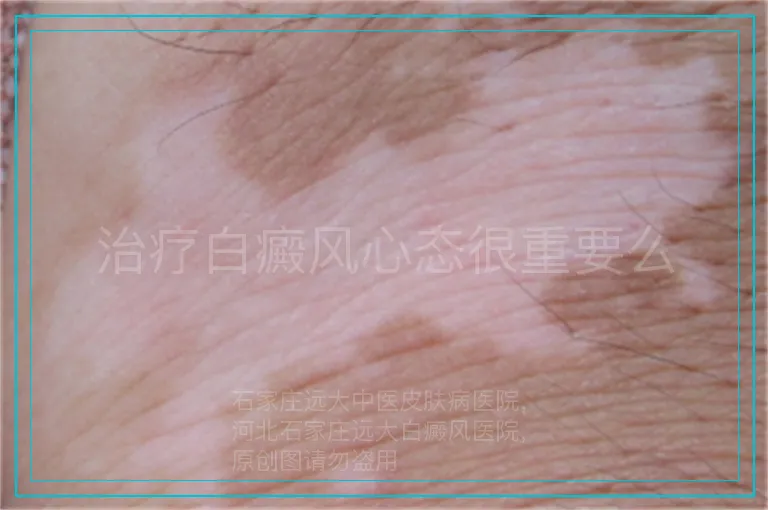 治疗白癜风心态很重要么