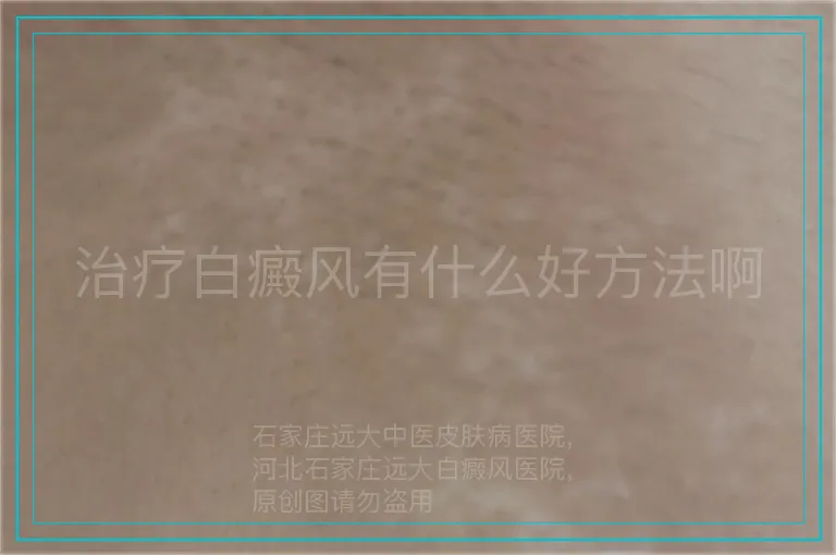 治疗白癜风有什么好方法啊