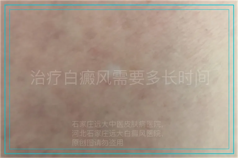 治疗白癜风需要多长时间