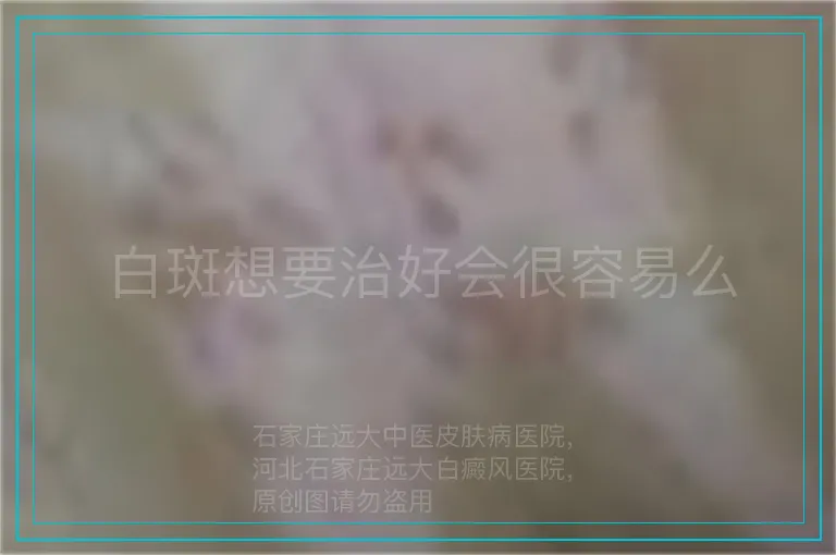 白斑想要治好会很容易么