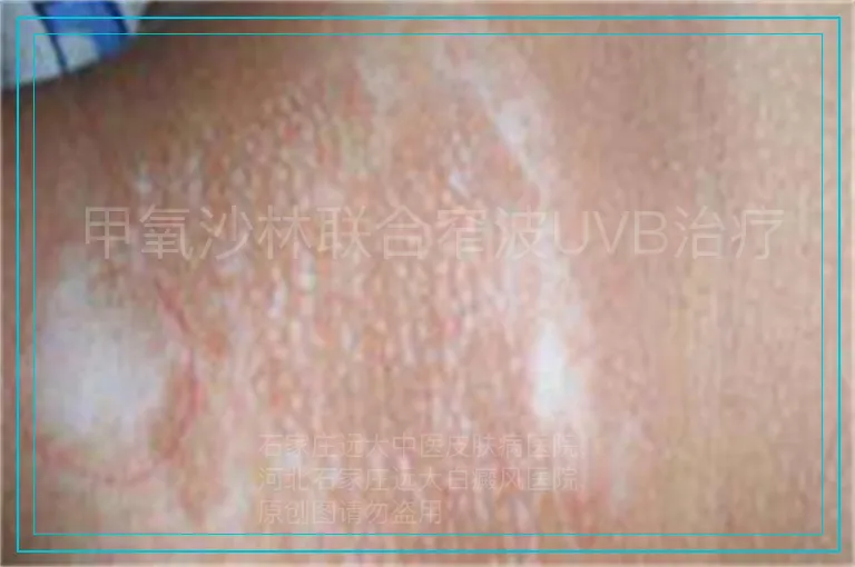 甲氧沙林联合窄波UVB治疗