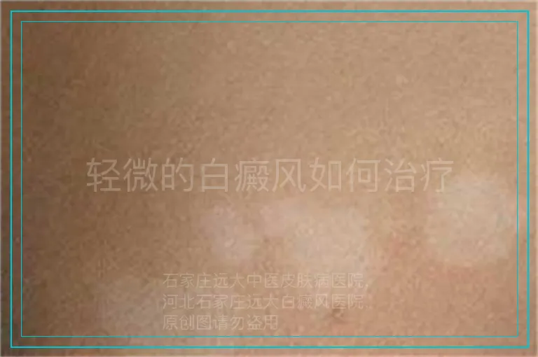 轻微的白癜风如何治疗
