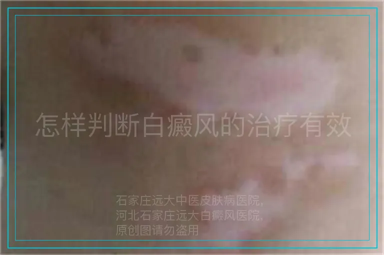 怎样判断白癜风的治疗有效