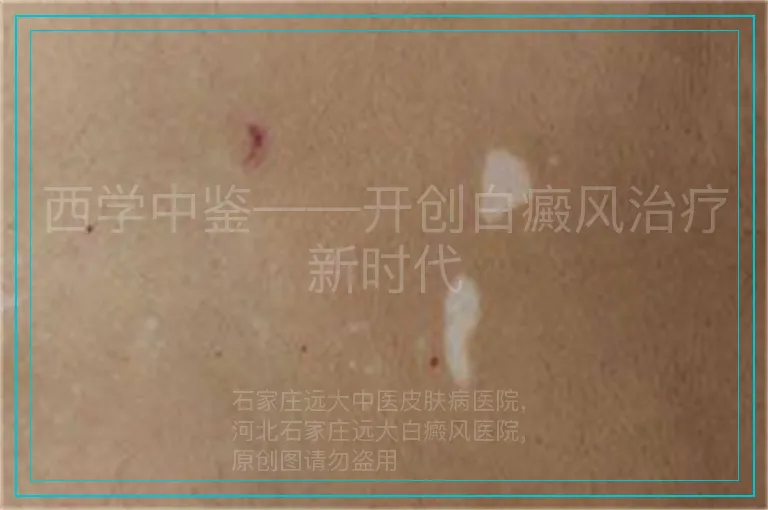 西学中鉴——开创白癜风治疗新时代
