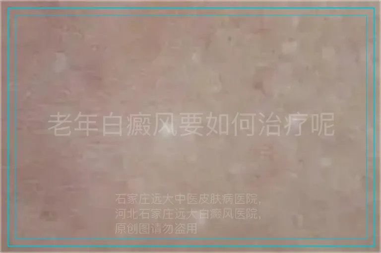 老年白癜风要如何治疗呢