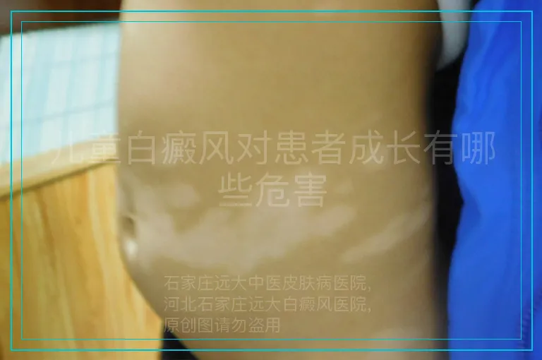 儿童白癜风对患者成长有哪些危害