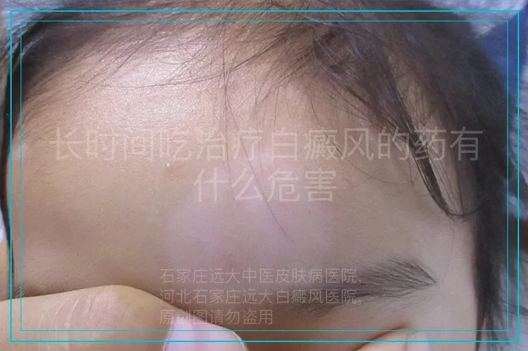 长时间吃治疗白癜风的药有什么危害