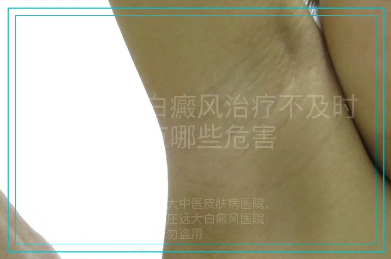皮肤上有白癜风治疗不及时会有哪些危害