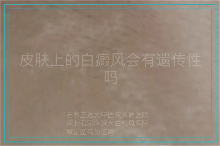 皮肤上的白癜风会有遗传性吗