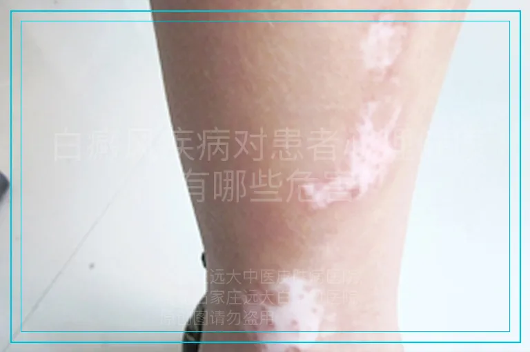 白癜风疾病对患者心理健康有哪些危害