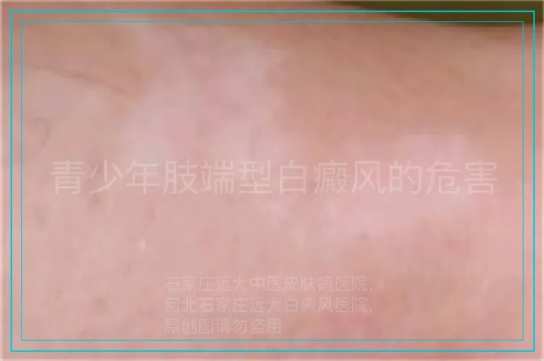 青少年肢端型白癜风的危害