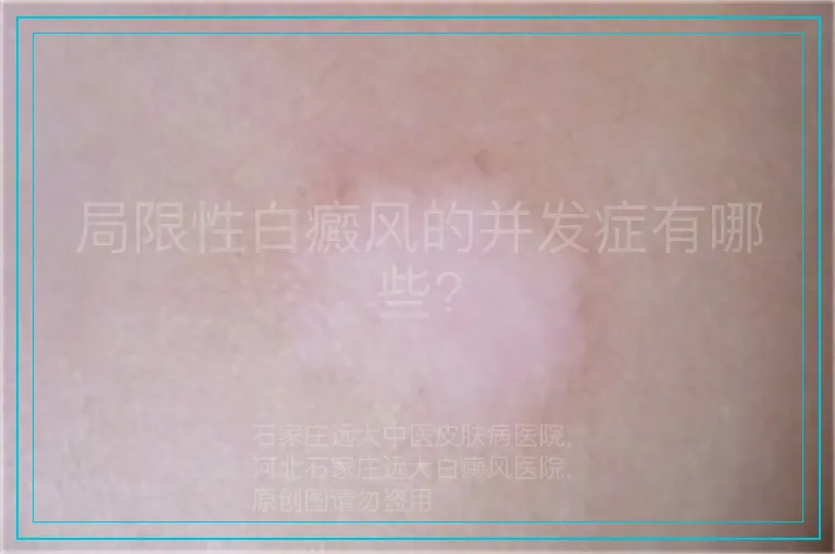 局限性白癜风的并发症有哪些?
