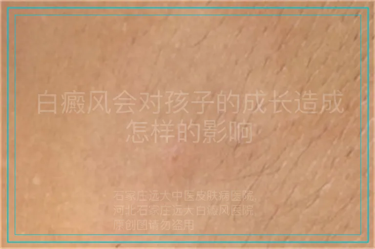 白癜风会对孩子的成长造成怎样的影响