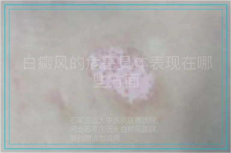 白癜风的危害具体表现在哪些方面